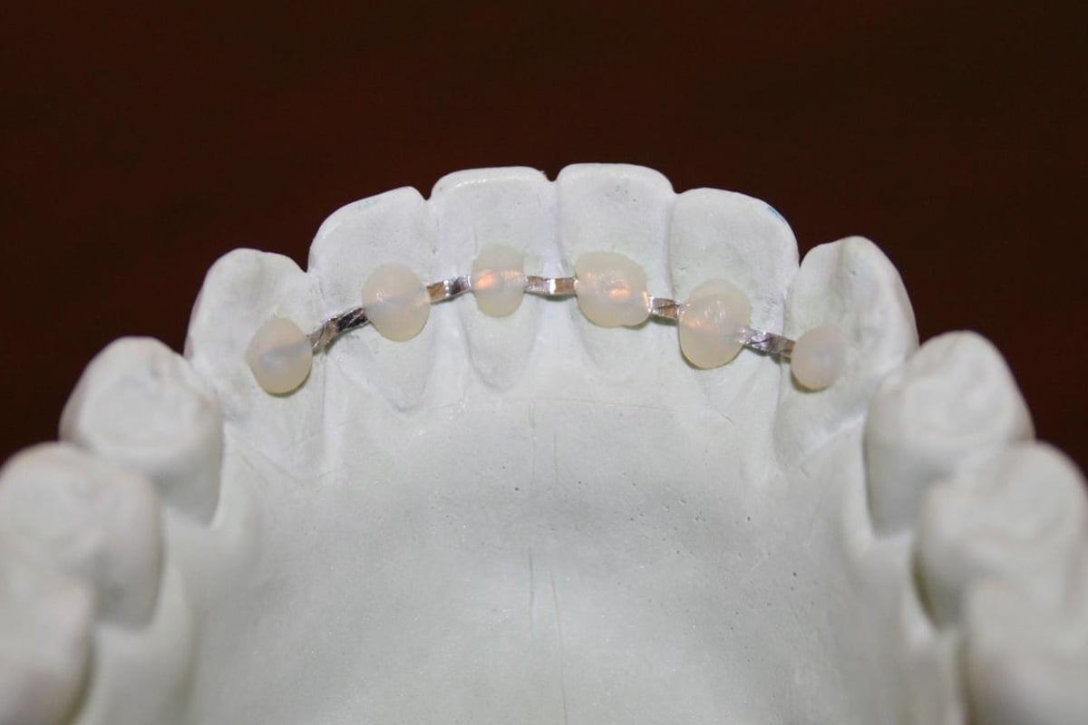 Increase Orthodontic Retention with Six Month Smiles